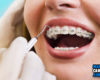 Manfaat dan Resiko Penggunaan Kawat Gigi Yang Mesti Kamu Tahu