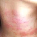 Obat Alergi Dingin Cepat, Mudah Dan Alami