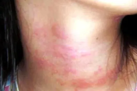 Obat Alergi Dingin Cepat, Mudah Dan Alami