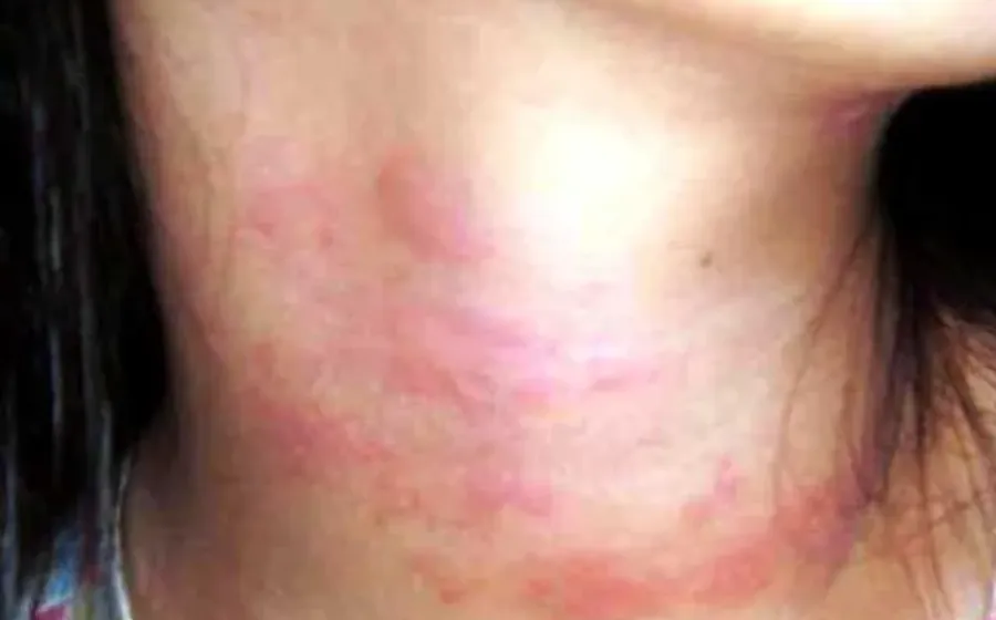 Obat Alergi Dingin Cepat, Mudah Dan Alami