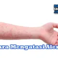 Cara Mengatasi Alergi Pada Tubuh Secara Alami
