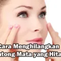 Cara Menghlangkan Kantong Mata Yang Hitam