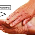 Cara Mengobati Asam Urat