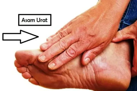 Cara Mengobati Asam Urat
