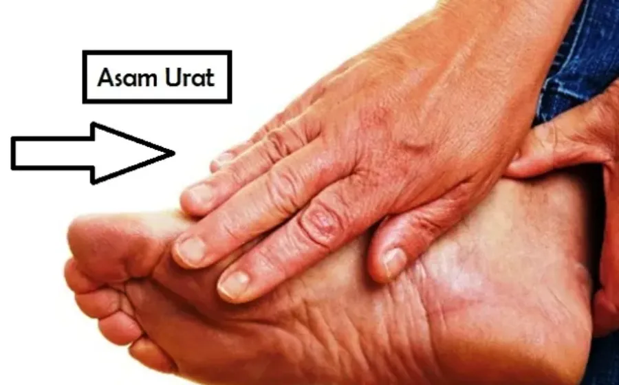 Cara Mengobati Asam Urat