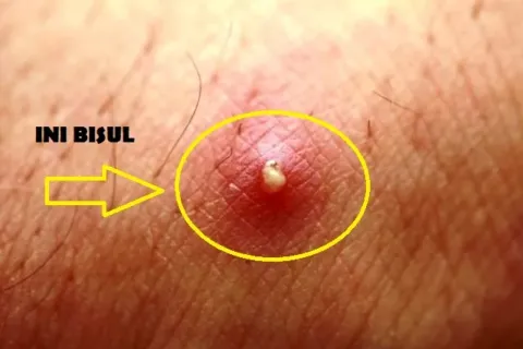 Cara Mengobati Bisul