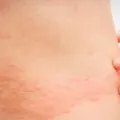 Cara Mengatasi Biduran Secara Alami