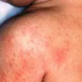 Cara Mengobati Biang Keringat