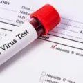 Cara Mengobati Hepatitis B Secara Alami