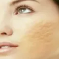 Cara Mudah Menghilangkan Bekas Jerawat Dengan Menggunakan Bahan Alami