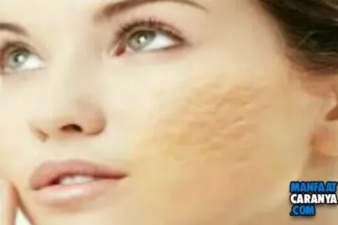 Cara Mudah Menghilangkan Bekas Jerawat Dengan Menggunakan Bahan Alami