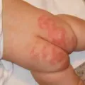 Cara Mengatasi Ruam Popok Pada Bayi