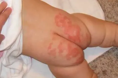 Cara Mengatasi Ruam Popok Pada Bayi