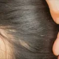 Cara Menghilangkan Kutu Rambut Secara Alami