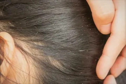 Cara Menghilangkan Kutu Rambut Secara Alami