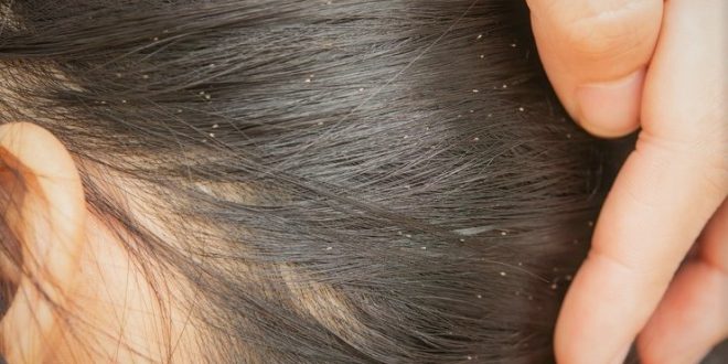 Cara Menghilangkan Kutu Rambut Secara Alami