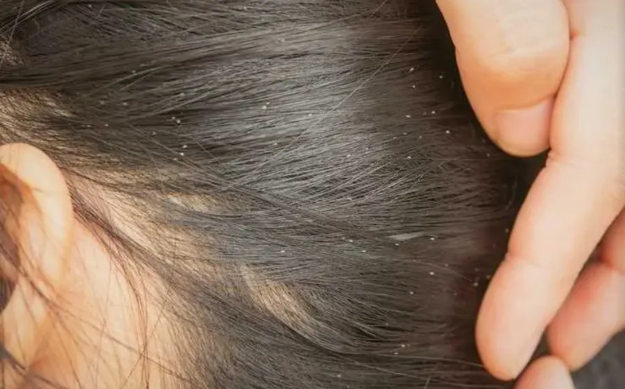 Cara Menghilangkan Kutu Rambut Secara Alami