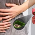 11 Penyebab Batu Empedu dan Cara Mengatasinya