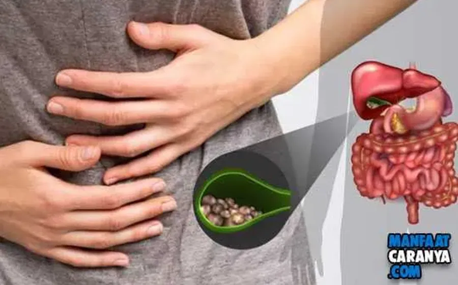 11 Penyebab Batu Empedu dan Cara Mengatasinya