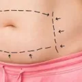7 Efek Samping Sedot Lemak dan Tips Merampingkan Tubuh