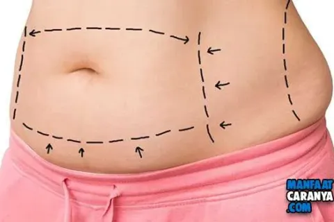 7 Efek Samping Sedot Lemak dan Tips Merampingkan Tubuh