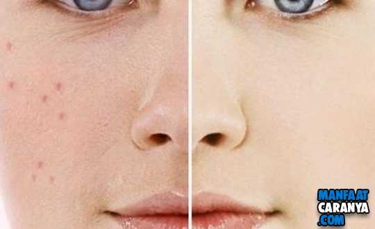 Cara Alami Hilangkan Bekas Jerawat