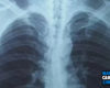 Cara Mencegah Paru-paru Basah, Kenali Gejala dan Penyebabnya!