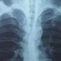 Cara Mencegah Paru paru Basah