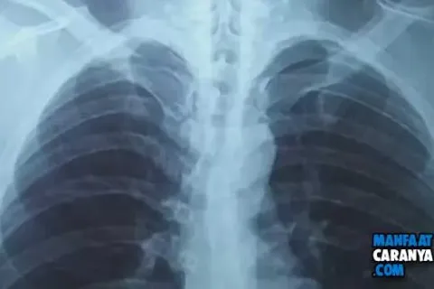 Cara Mencegah Paru paru Basah