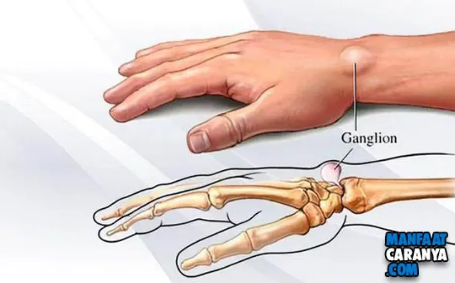 Kista Ganglion, Benjolan Pada Persendian Yang Sering Diabaikan