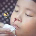 Penyebab dan Cara Mengatasi Mimisan Pada Anak