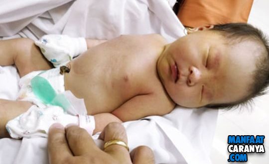 Tips Mengatasi Penyakit Kuning Pada Bayi Baru lahir
