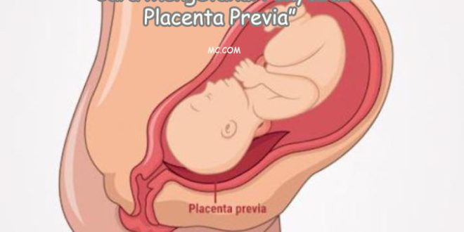 Cara Tahu Penyebab Placenta Previa