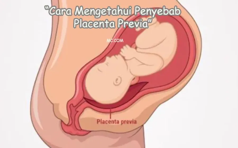 Cara Tahu Penyebab Placenta Previa