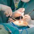 Lawan Obesitas Dengan Bariatik Surgery, Operasi Pemotongan Lambung Yang Viral