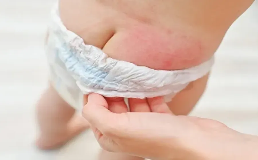Manfaat Penggunaan Cream Ruam Popok
