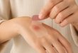 Second Skin Protection, Plester Canggih yang Bikin Luka Kecil Sembuh Lebih Cepat